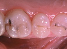 Zuby pipraven k plombovn po odstrann zubnho kazu pomoc VECTORU